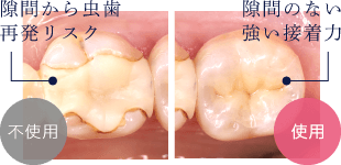 不使用:隙間から虫歯再発リスク、使用:隙間のない強い接着力