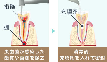 虫歯菌が感染した歯質や歯髄を除去して、消毒後、充填剤を入れて密封