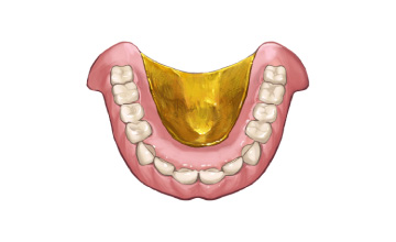 金合金床義歯