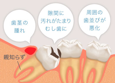 歯茎の腫れ・隙間に汚れがたまりむし歯に・周囲の歯並びが悪化